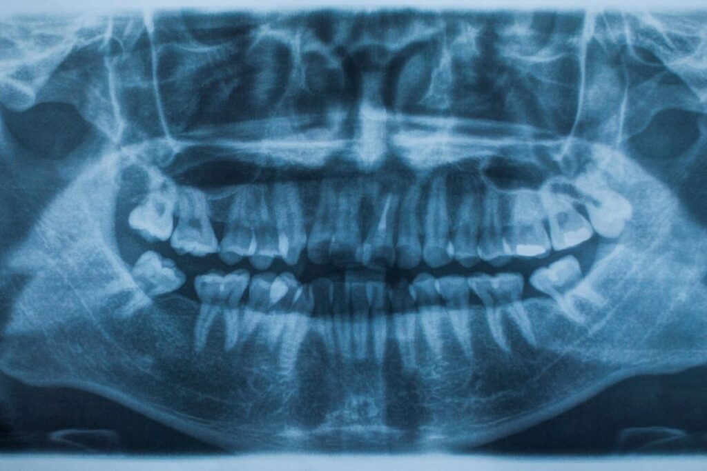 dental injury